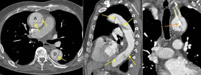 Thoracic Aortic Dissection Ct Radiology At St Vincents University