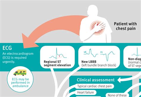 Acute Coronary Syndromes The Bmj