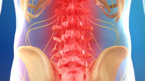 Day Case Lumbar Decompression Surgery London Spine Unit Uks Best