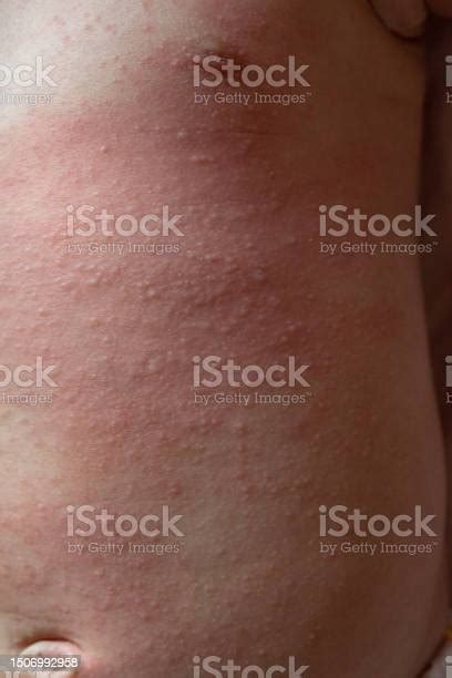 Red Itchy Rash On Babys Chest And Abdomen Stock Photo Download Image