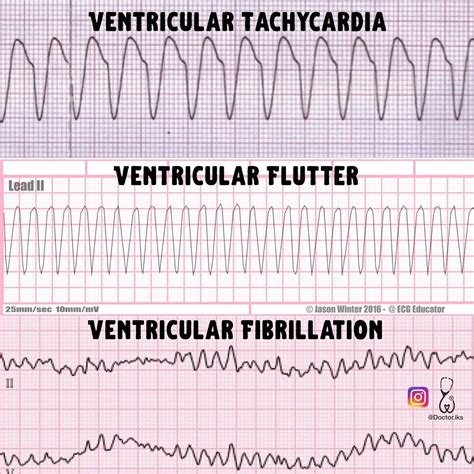 Difference Between Ventricular Tachycardia Vtach And 57 Off