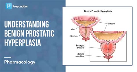 Understanding Benign Prostatic Hyperplasia BPH