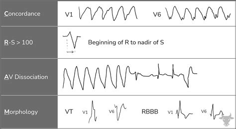 Ventricular Tachycardia Ecg Stampede