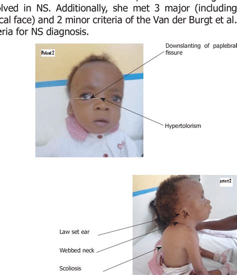 A B Photograph Of Patient 2 With Definite Noonan Syndrome 2 Year