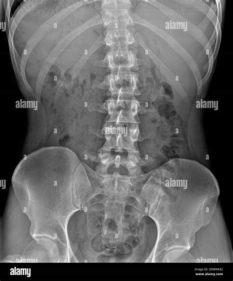 Lumbar Vertebrae Anatomy Xray