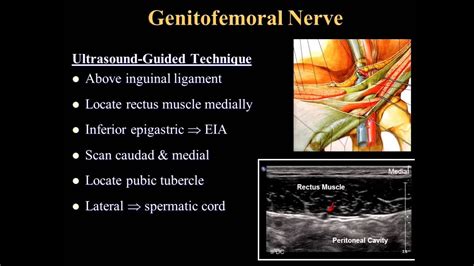 Ultrasound Guided Ilioinguinal Nerve Block