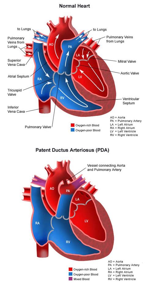 Patent Ductus Arteriosus Childrens Hospital Of Orange County