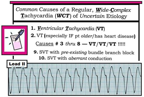 Ventricular Tachycardia Vs Supraventricular Tachycardia