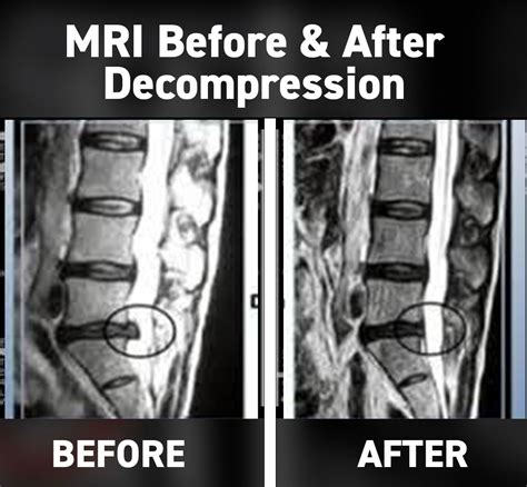 Westchester Spinal Decompression Center White Plains Disc Doctor