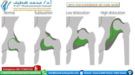 Hip Dysplasia Description Pathogenesis