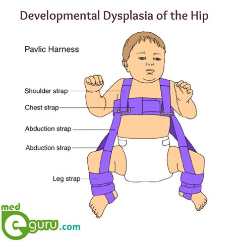 What Is Hip Dysplasia Or Congenital Hip Dislocation Medegurumed E Guru