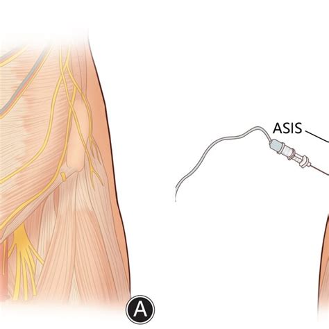 Schematic Diagram Of The Iliohypogastric Ilioinguinal Nerve Block