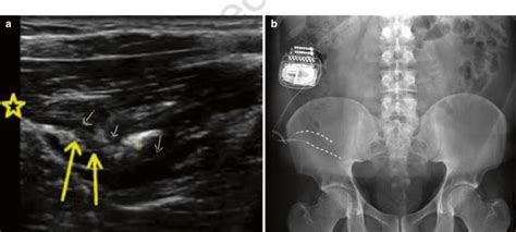 Cryoneuroablation Of The Ilioinguinal Nerve Eom External Oblique