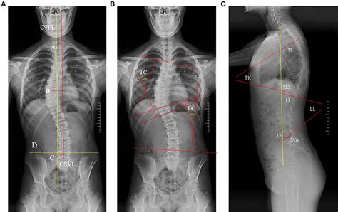 Frontiers Coronal Balance Vs Sagittal Profile In Adolescent