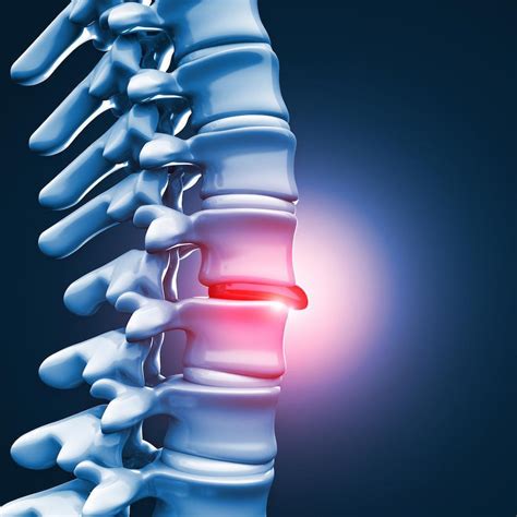 Warning Signs You Have A Herniated Disc John Regan MD Orthopedic