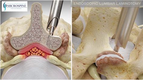 04 Endoscopic Lumbar Decompression Youtube