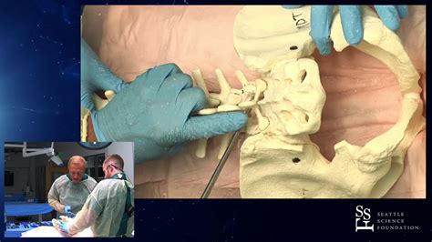 Efficient Posterior Lumbar Decompression Surgery Jens R Chapman Md