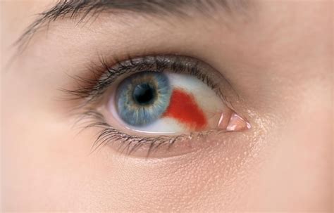 Premium Photo Burst Blood Vessel In Eye