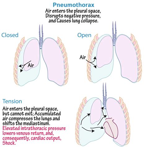 Pathology Glossary Pneumothorax Draw It To Know It