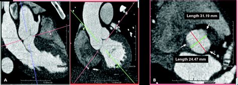 Ct And Mri Assessment Of The Aortic Root And Ascending Aorta Ajr