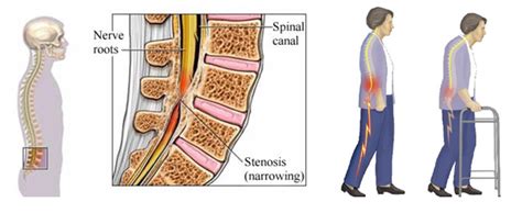 Lumbar Spine Decompression Of Lumbar Spine