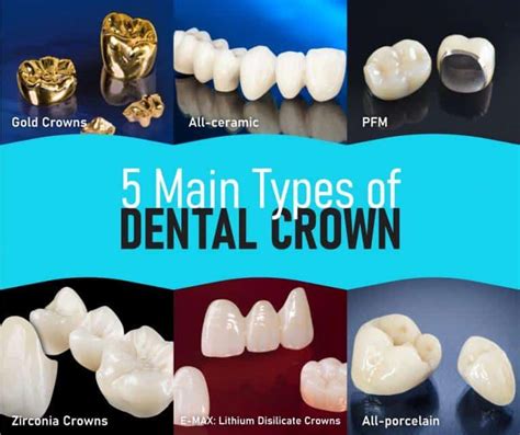 Types Of Dental Crowns Procedure And Cost