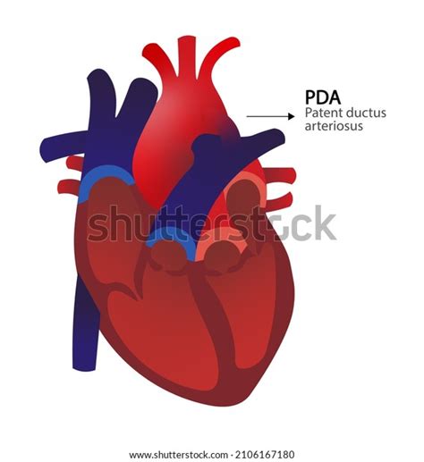 Patent Ductus Arteriosus Pda Anatomy Heart Stok İllüstrasyon 2106167180