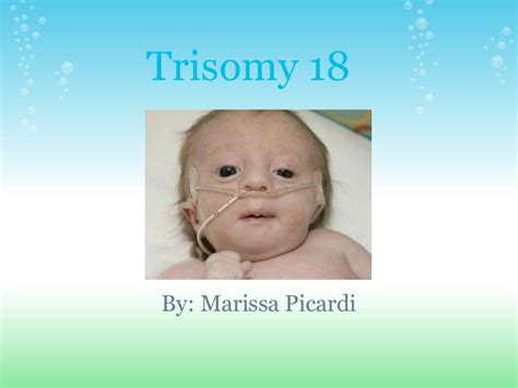 Edwards Syndrome Or Trisomy 18 Doctor Tipster