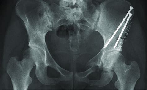 Bilateral Hip Dysplasia When To Preserve And When To 52 Off