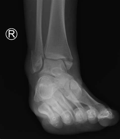 Anterior process of the calcaneus. Ankle Fractures - Core EM