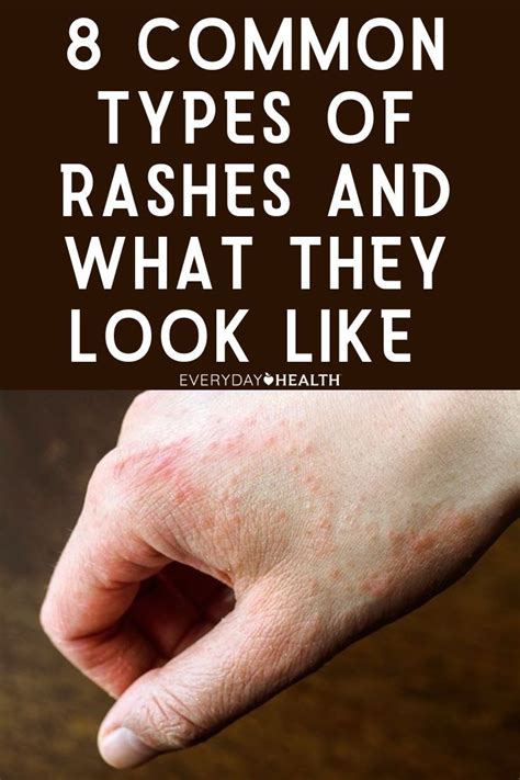 8 Common Types Of Rashes And What They Look Like Artofit