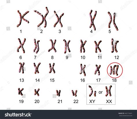 Trisomy 18 Diagram