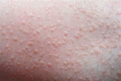 Heat Rash Causes Symptoms Treatment And Prevention