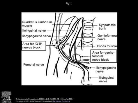 Evaluation Of Genitofemoral Nerve Block In Addition To Ilioinguinal