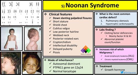 Noonan Syndrome