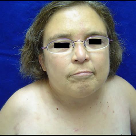 Noonan Syndrome Characteristic Facial Features Including A Broader