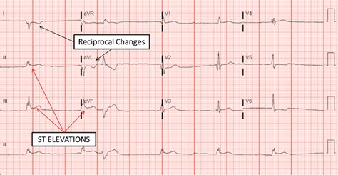 Stemi Electrocardiogram M3 Curriculum Saem