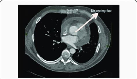 Dissection Aorta Ct