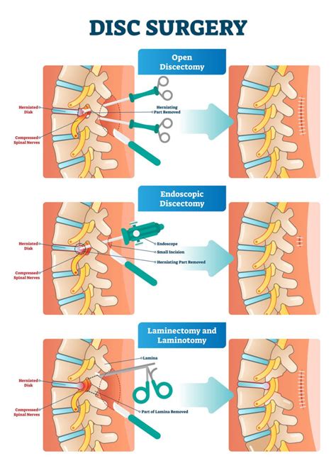 Endoscopic Lumbar Discectomy Recovery Time At Willie Culver Blog