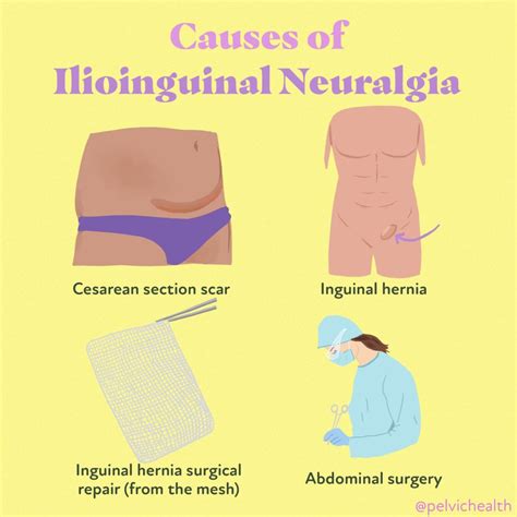 Ilioinguinal Nerve Entrapment