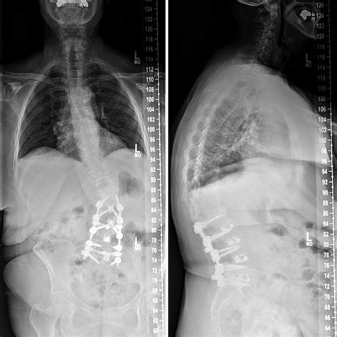 Anteroposterior Left And Lateral Right Scoliosis Radiographs