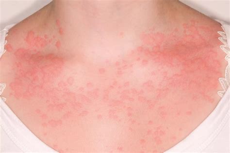 Hives On Neck And Chest