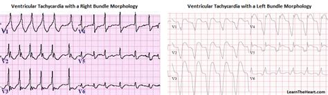 Ventricular Tachycardia Vs Supraventricular Tachycardia