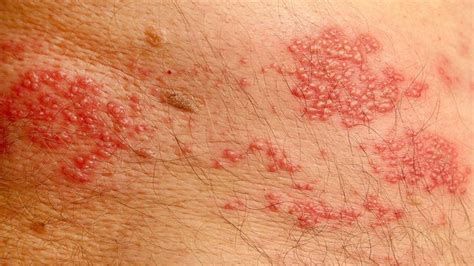 8 Common Types Of Rashes And What They Look Like Artofit