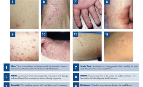 8 Common Types Of Rashes Types Of Rashes Common Skin Rashes Types