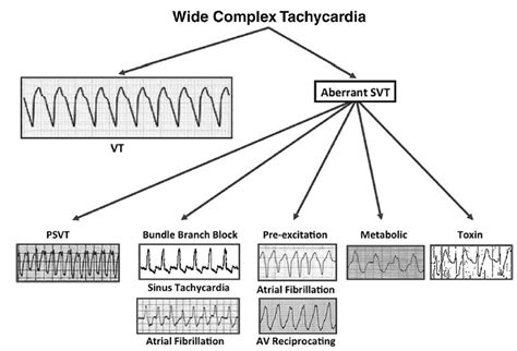 Difference Between Ventricular Tachycardia And Svt