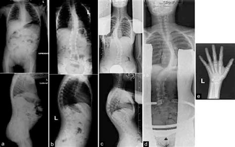 Serial Standing Scoliosis Radiographs Ad Preoperative Ap And