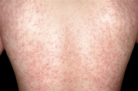 Pityriasis Rosea Nhs