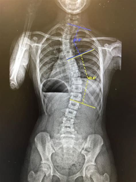 Xray Versus Eos For Scoliosis Schroth Scoliosis