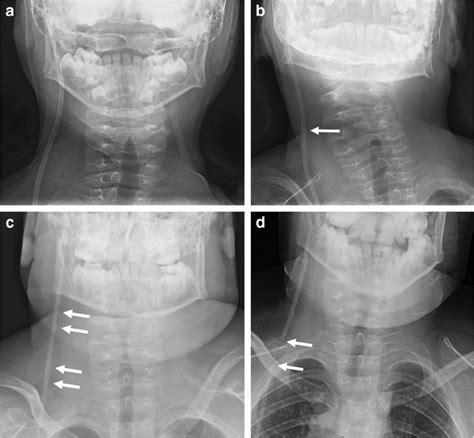 Sequential Shunt Series Radiographs In A Male Patient With